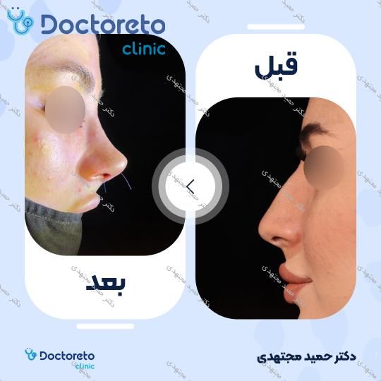 جراحی زیبایی بینی