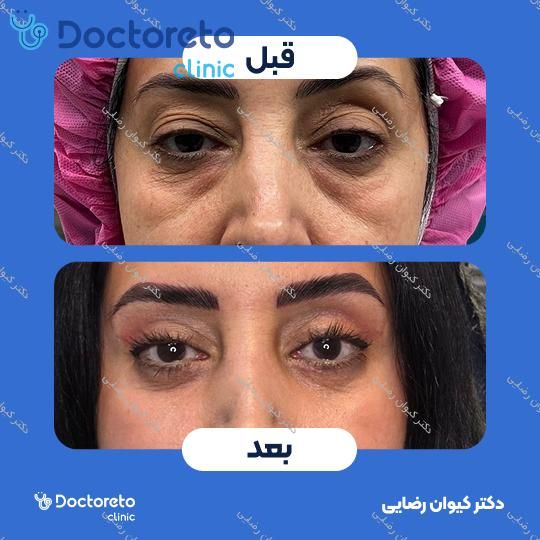 رفع افتادگی پلک (بلفاروپلاستی)