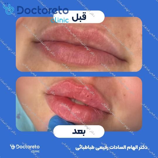 تزریق ژل صورت