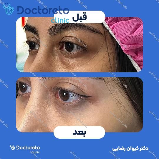رفع افتادگی پلک (بلفاروپلاستی)