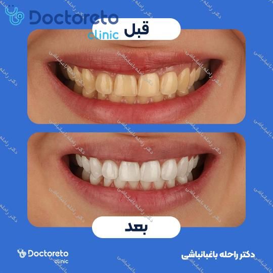 لمینت دندان (هر واحد)