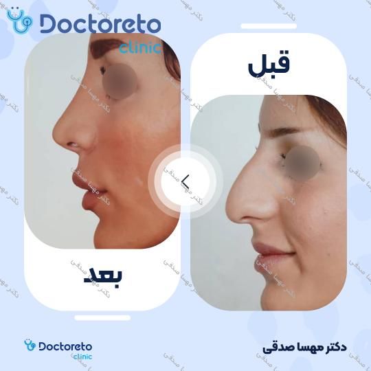 عمل انحراف بینی