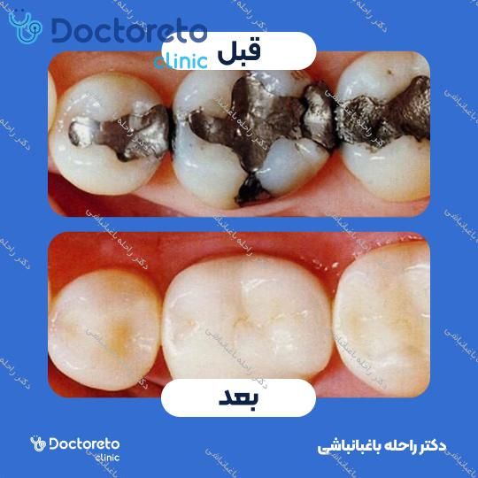 پر کردن دندان