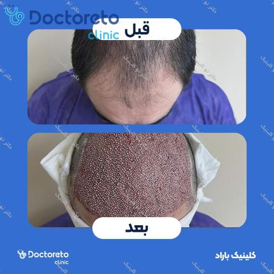 نمونه های کاشت مو