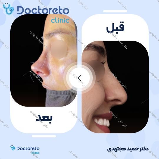 جراحی زیبایی بینی