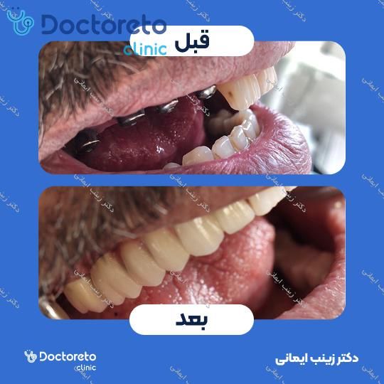 روکش دندان (هر واحد)