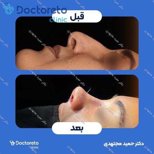 جراحی بینی ترمیمی