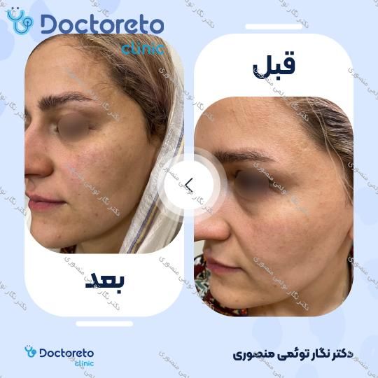 هایفوتراپی صورت، گردن و غبغب با دستگاه اولترا (1 جلسه)