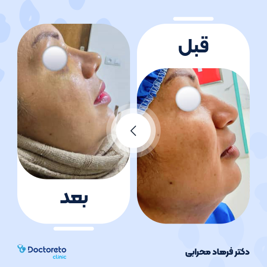 عمل زیبایی بینی (رینوپلاستی)