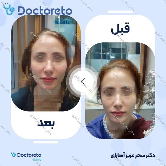 جوانسازی صورت (فول فیس) به روش تزریق چربی