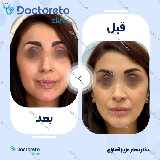 تزریق ژل چانه