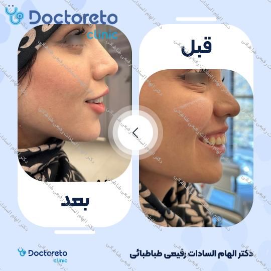 تزریق ژل صورت