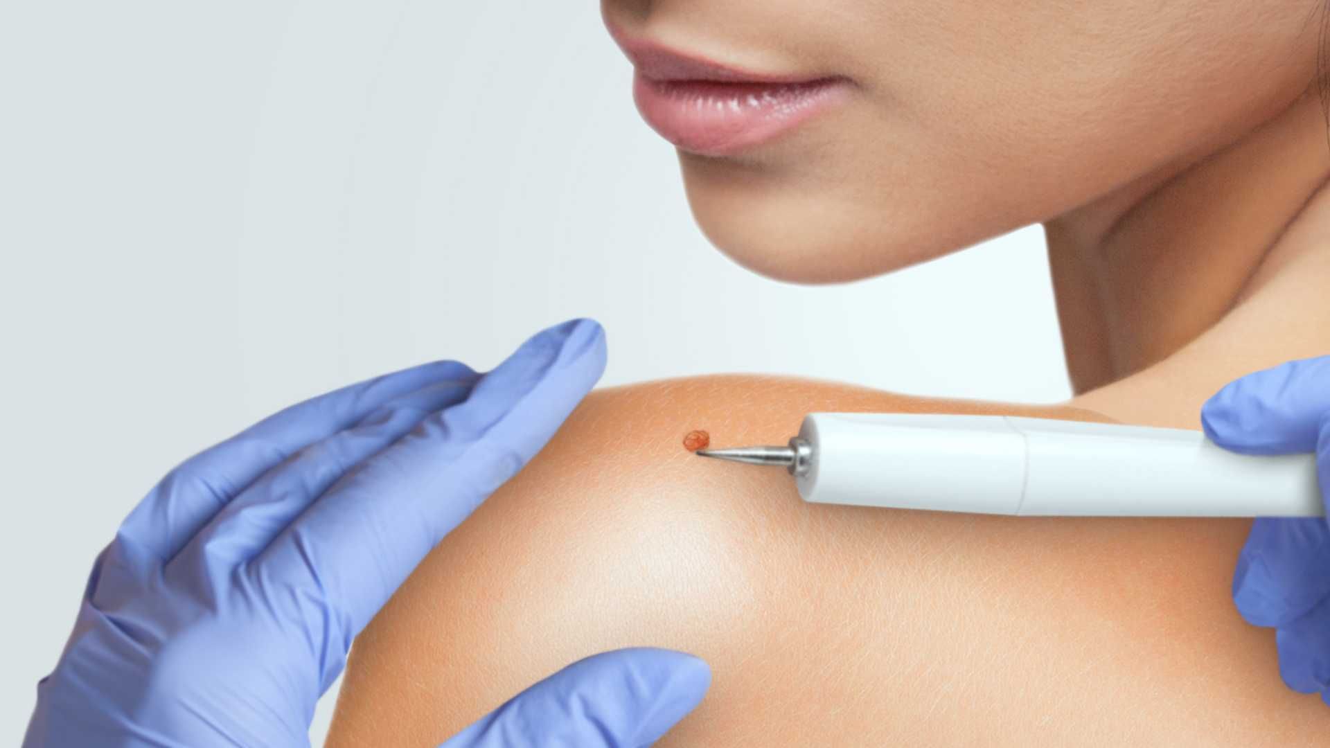 خال برداری نواحی صورت با لیزر اولترا CO2