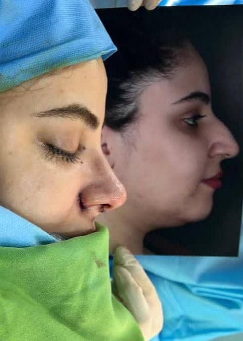 لمینت سرامیکی ایمکس آلمانی (هر واحد)