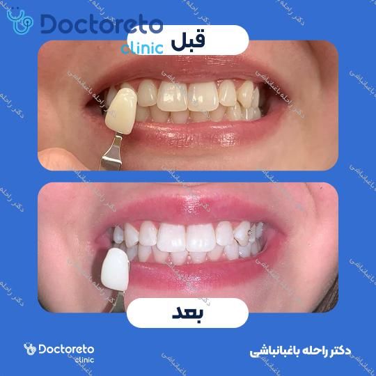 بلیچینگ دندان