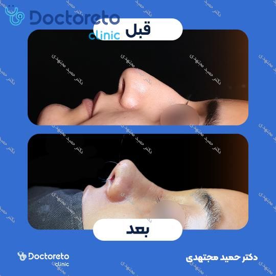 جراحی بینی ترمیمی