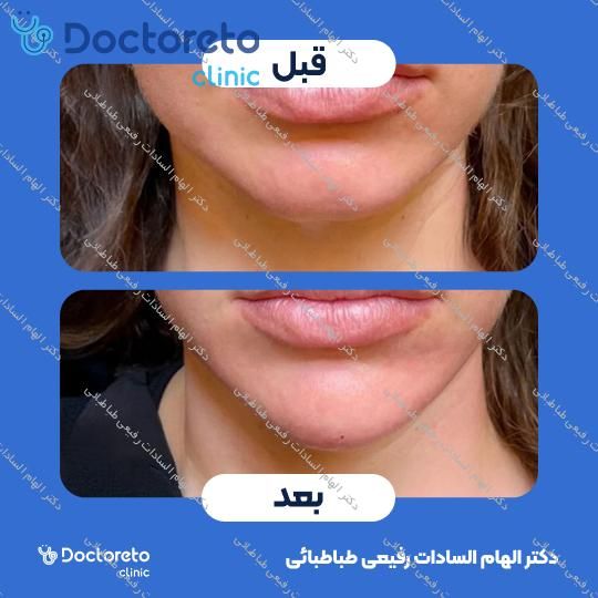 تزریق ژل صورت