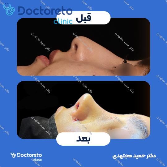 جراحی بینی ترمیمی