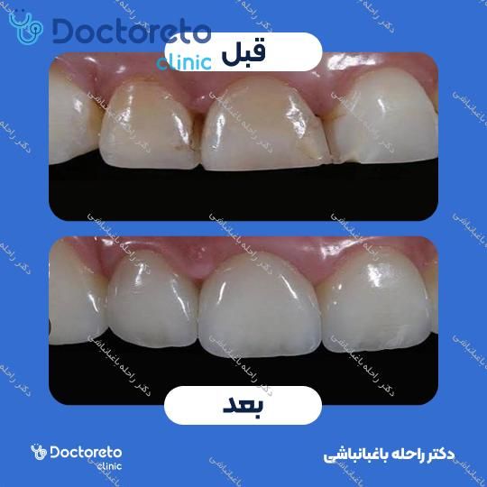 پر کردن دندان