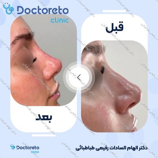 تزریق ژل صورت