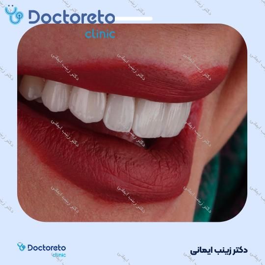 لمینت سرامیکی دندان (هر واحد)