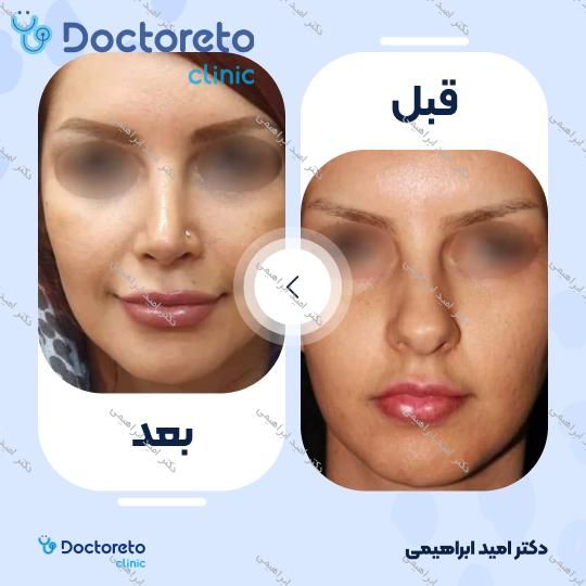 عمل جراحی مجدد زیبایی بینی (رینوپلاستی)