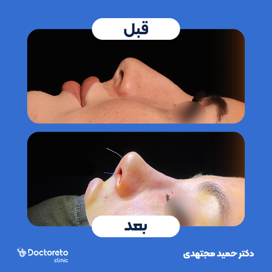 جراحی بینی ترمیمی