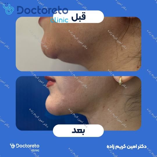 عمل لیپوساکشن غبغب