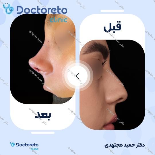 جراحی زیبایی بینی