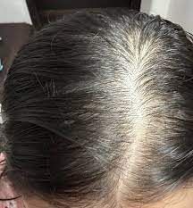 آزمایش ریزش مو در زنان