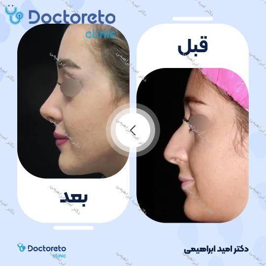 عمل جراحی مجدد زیبایی بینی (رینوپلاستی)