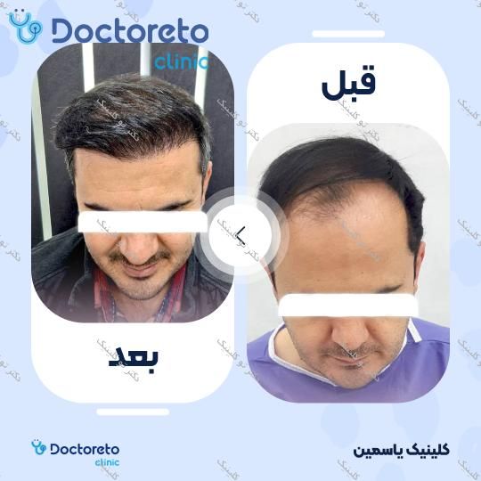 نمونه های کاشت مو