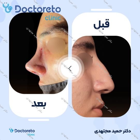 جراحی زیبایی بینی