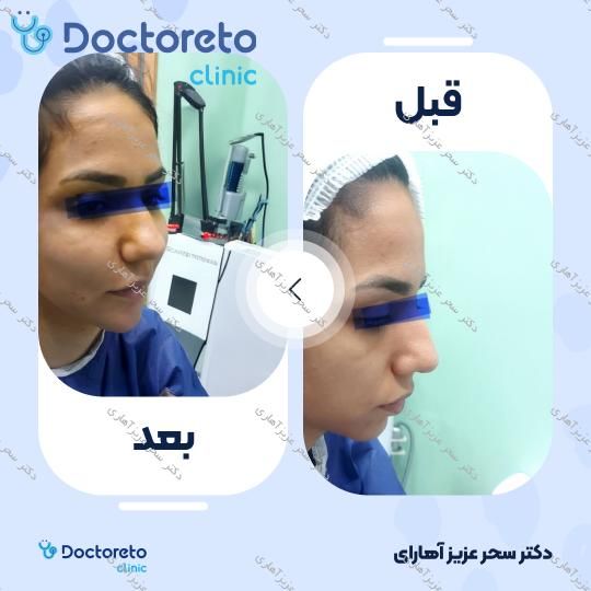 جوانسازی صورت (فول فیس) به روش تزریق چربی
