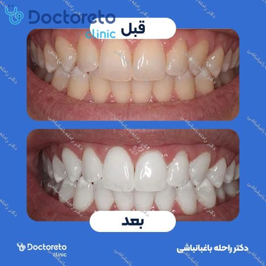 بلیچینگ دندان