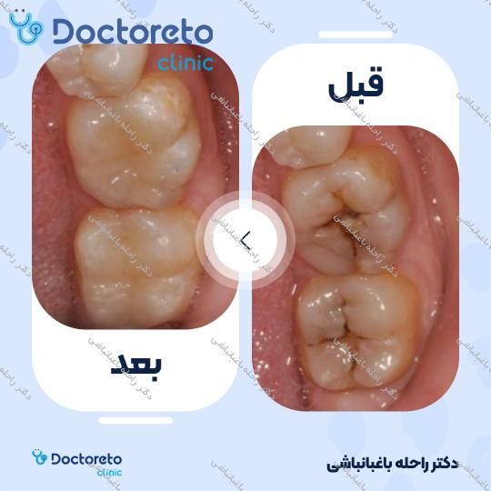 پر کردن دندان