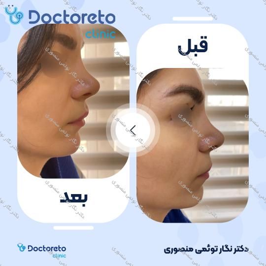 تزریق ژل چانه با برند نورامیس (1CC)