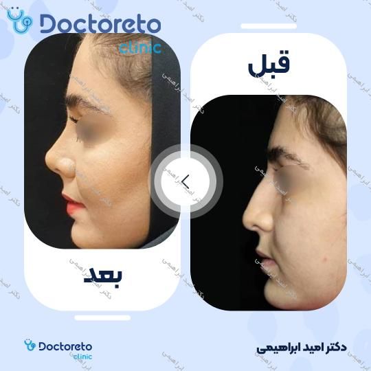 عمل جراحی مجدد زیبایی بینی (رینوپلاستی)