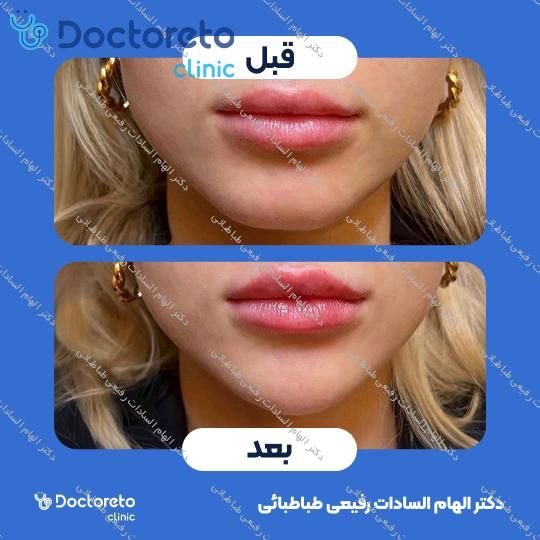 تزریق ژل صورت