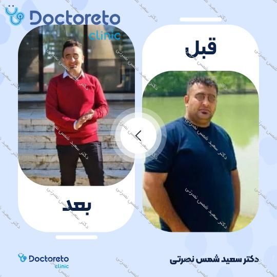 جراحی اسلیو معده