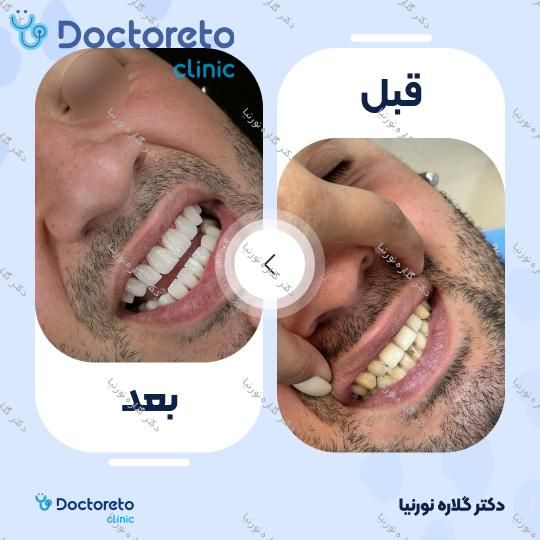 لمینت سرامیکی دندان IPS (هر واحد)