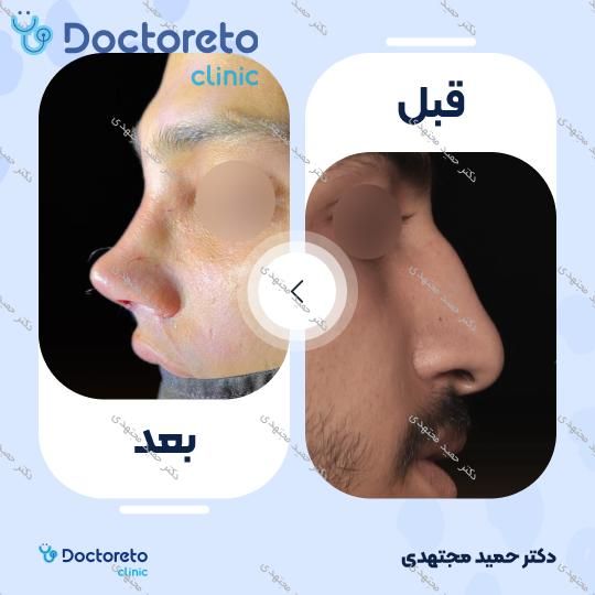 جراحی زیبایی بینی