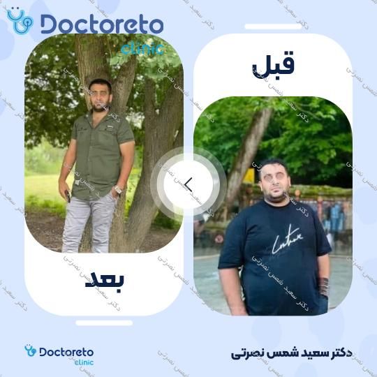 جراحی اسلیو معده