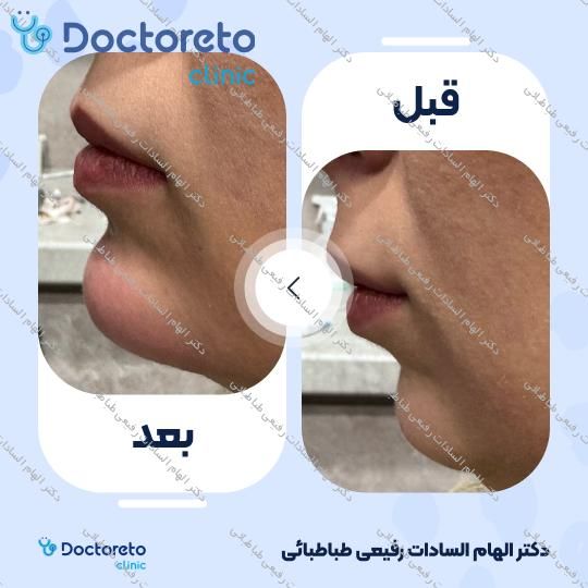 تزریق ژل صورت