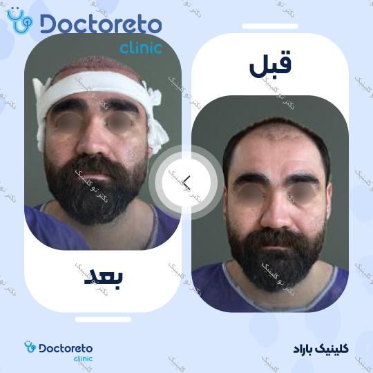 نمونه های کاشت مو
