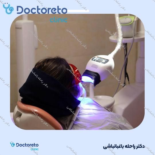 لمینت دندان (هر واحد)