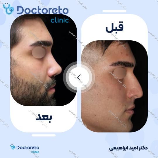 عمل جراحی مجدد زیبایی بینی (رینوپلاستی)