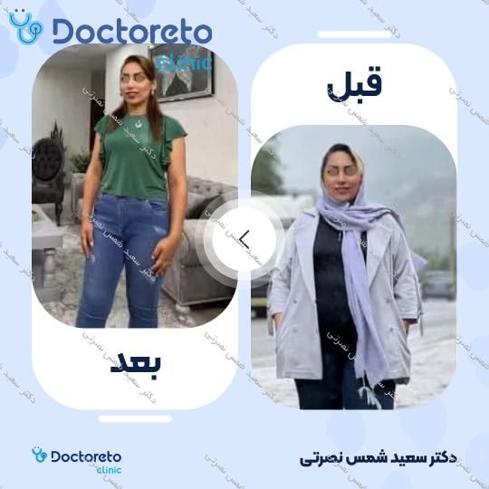 جراحی اسلیو معده