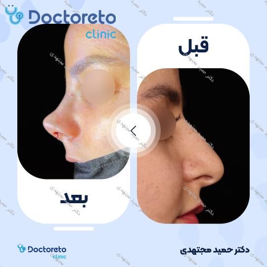 جراحی زیبایی بینی