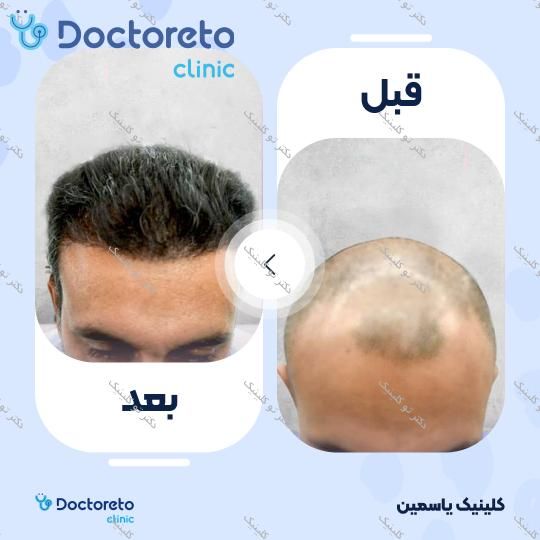 نمونه های کاشت مو
